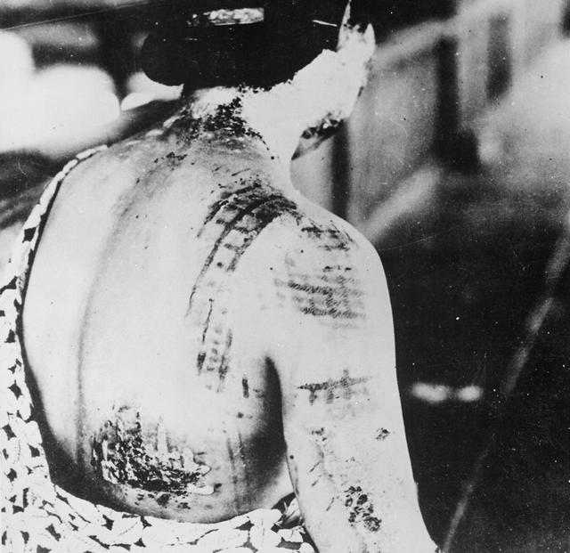 广岛核爆炸后的画面：烧伤将衣服上的花纹，直接印在了身上！